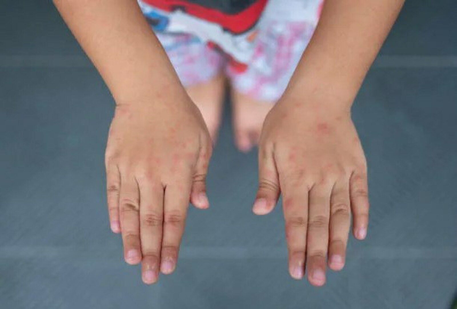 В Башкортостане более двух десятков детей заразились вирусом Коксаки